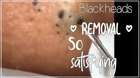 blackhead removal - youtube